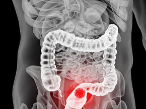 人体肠梗阻 大肠小肠 人体器官 人体组织3d模型