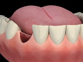 口腔 牙齿 牙齿放入骨块缝合手术